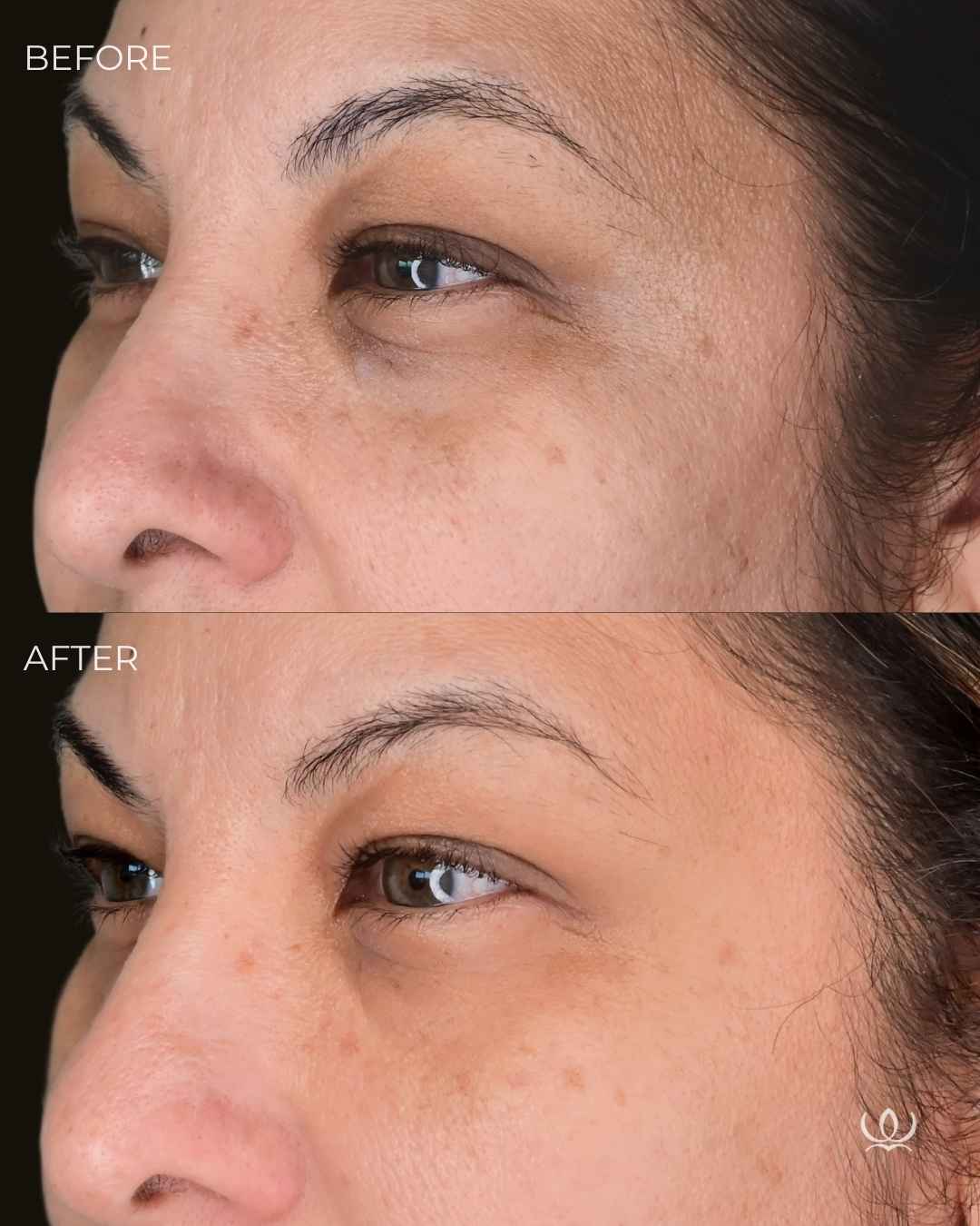 PRP under-eyes before and after — West Empire Aesthetics, Brentwood
