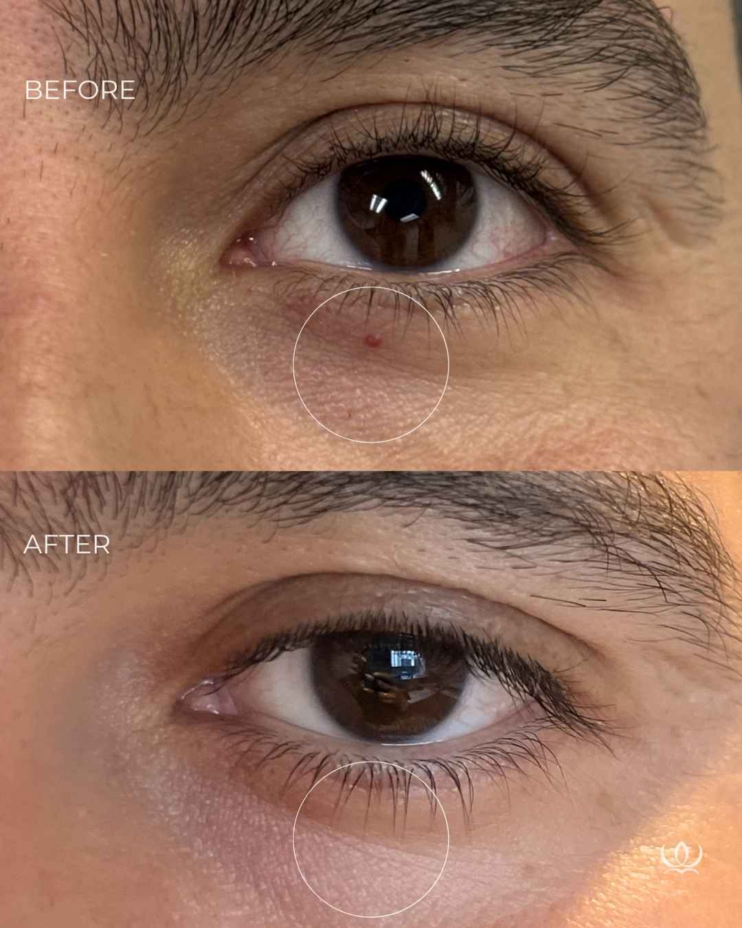 Cherry angioma before and after — West Empire Aesthetics, Brentwood