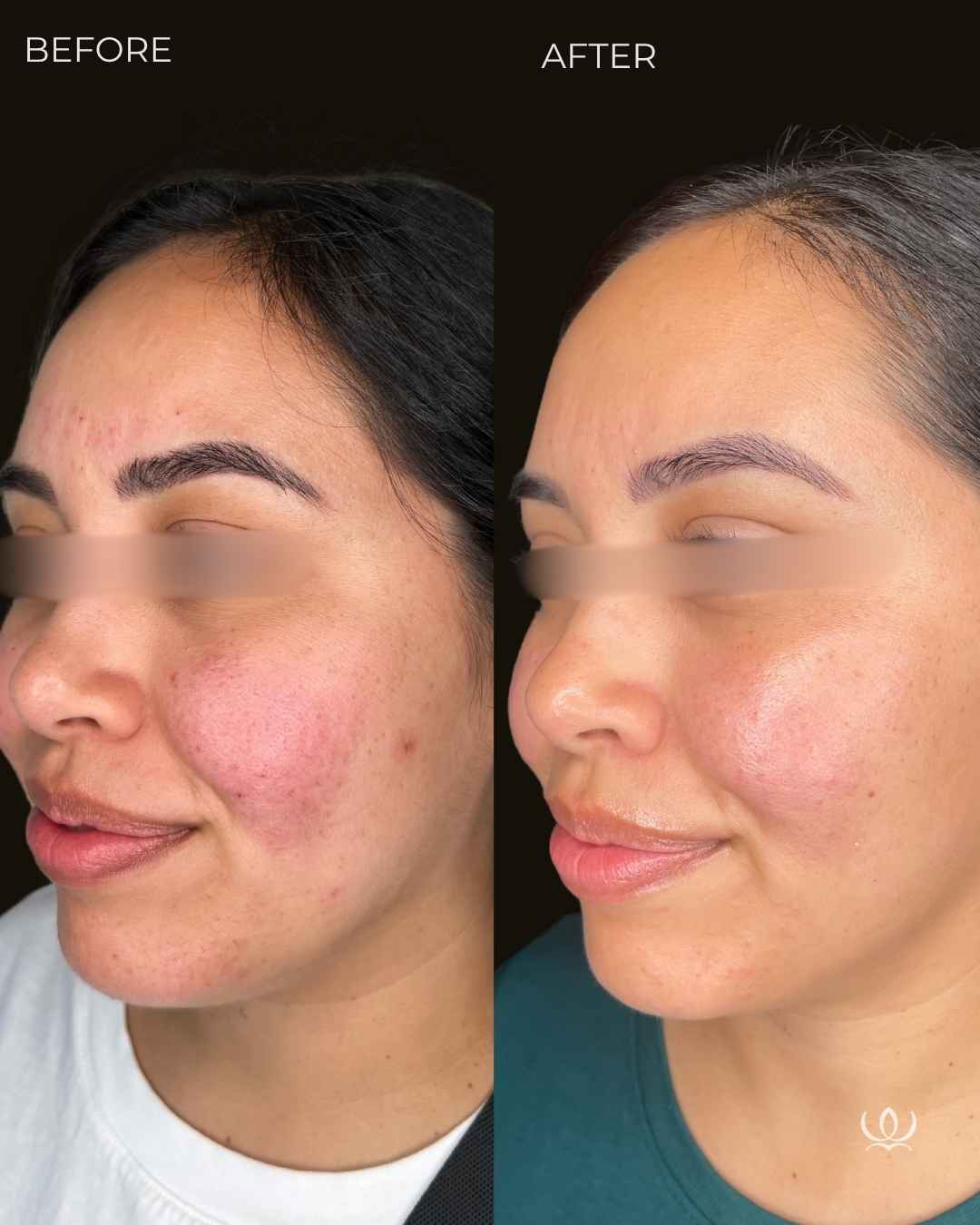 Rosacea before and after — West Empire Aesthetics, Brentwood