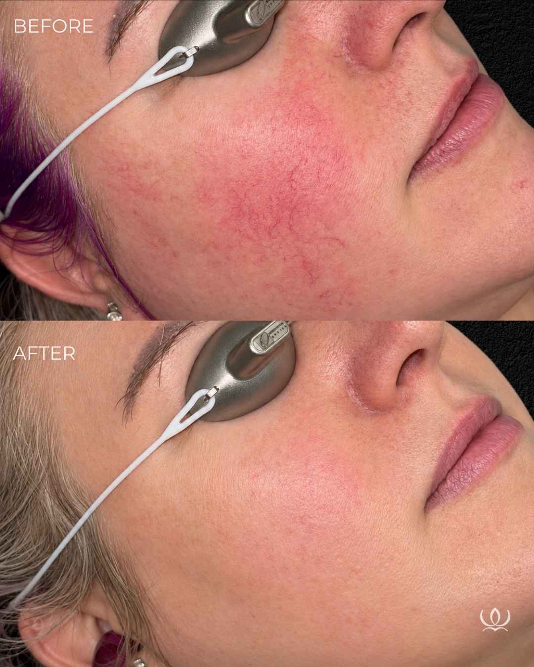 Rosacea before and after — West Empire Aesthetics, Brentwood