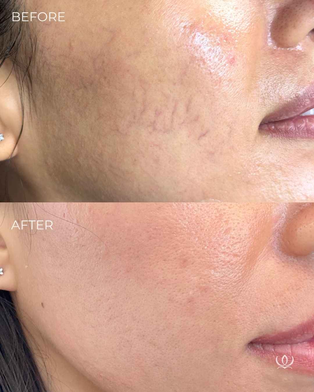 Broken vessels before and after — West Empire Aesthetics, Brentwood