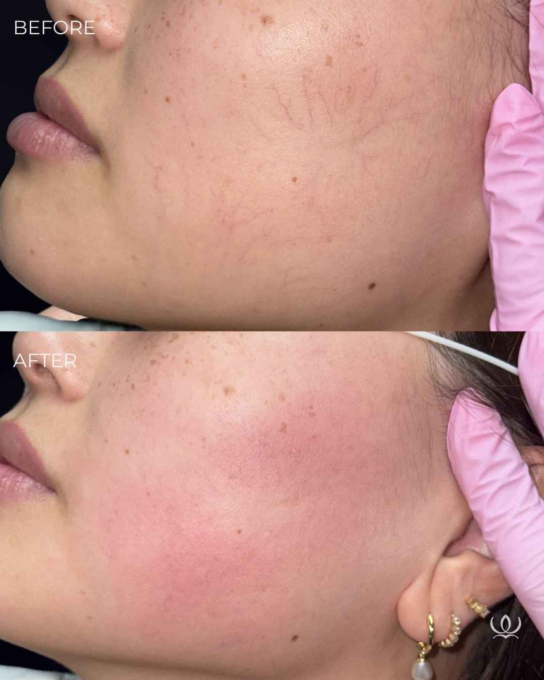 Broken vessels before and after — West Empire Aesthetics, Brentwood